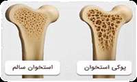 پوکی استخوان و سندرم تخمدان پلی کیستیک